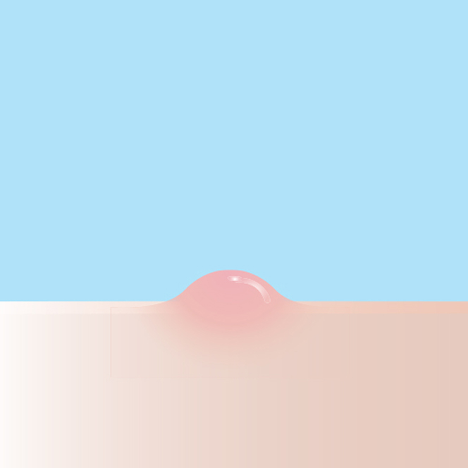 초기 트러블 빠른 진정