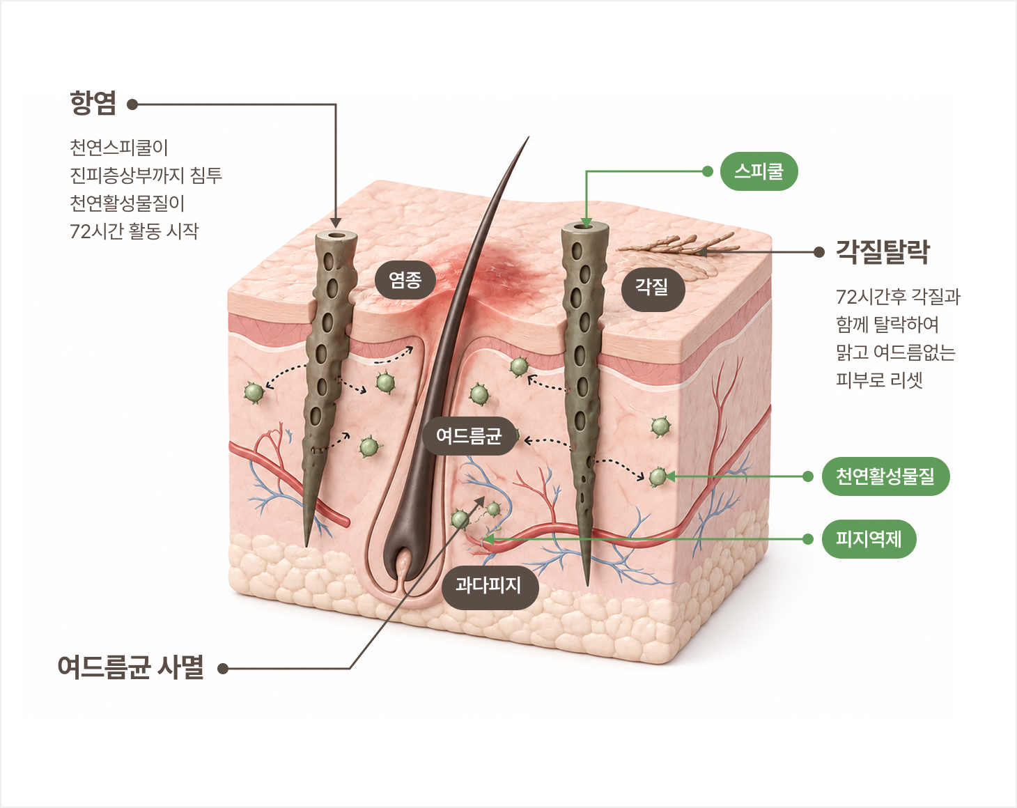 마이크로필 시술 이미지